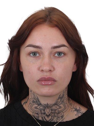 Blepharoplasty Before & After Gallery - Patient 236095 - Image 2