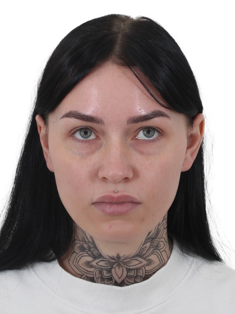 Blepharoplasty Before & After Gallery - Patient 236095 - Image 3