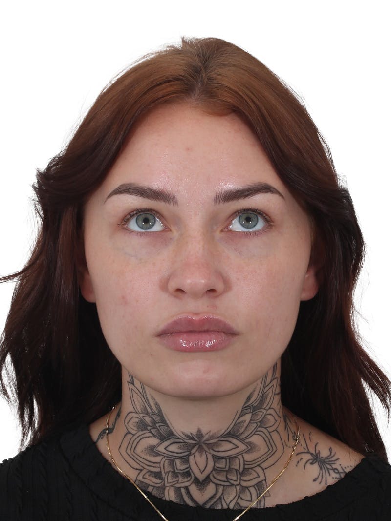 Blepharoplasty Before & After Gallery - Patient 236095 - Image 4