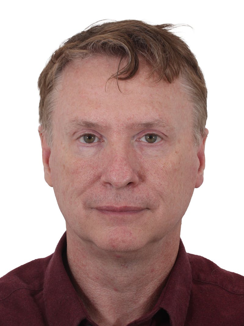 Laser Treatment Before & After Gallery - Patient 223493 - Image 1