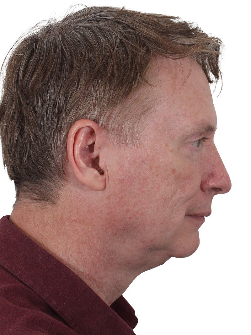 Laser Treatment Before & After Gallery - Patient 223493 - Image 3
