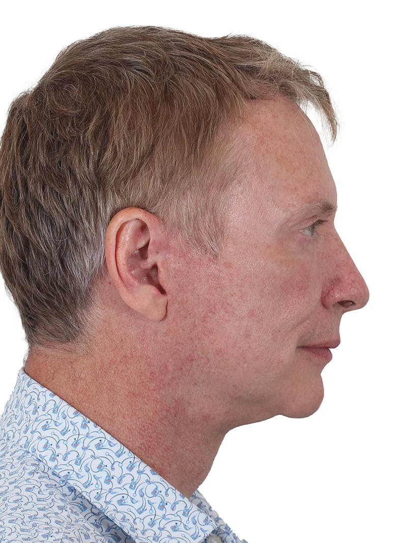 Laser Treatment Before & After Gallery - Patient 223493 - Image 4
