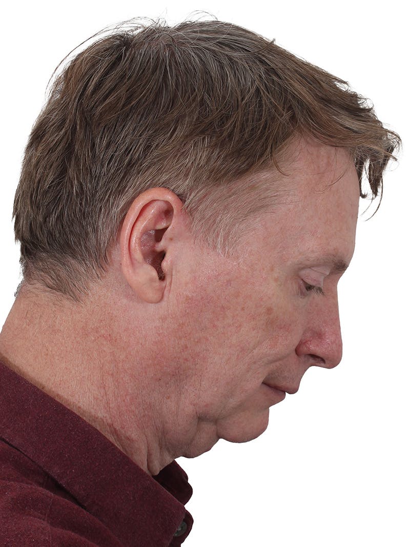 Laser Treatment Before & After Gallery - Patient 223493 - Image 5
