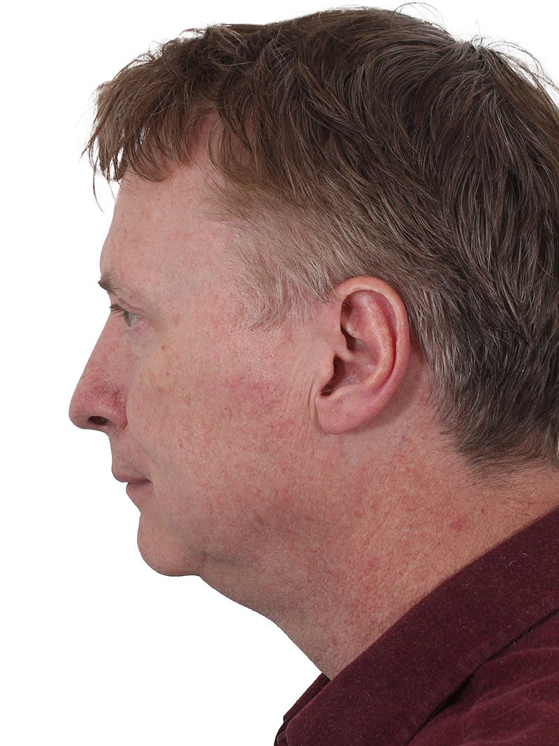 Laser Treatment Before & After Gallery - Patient 223493 - Image 7