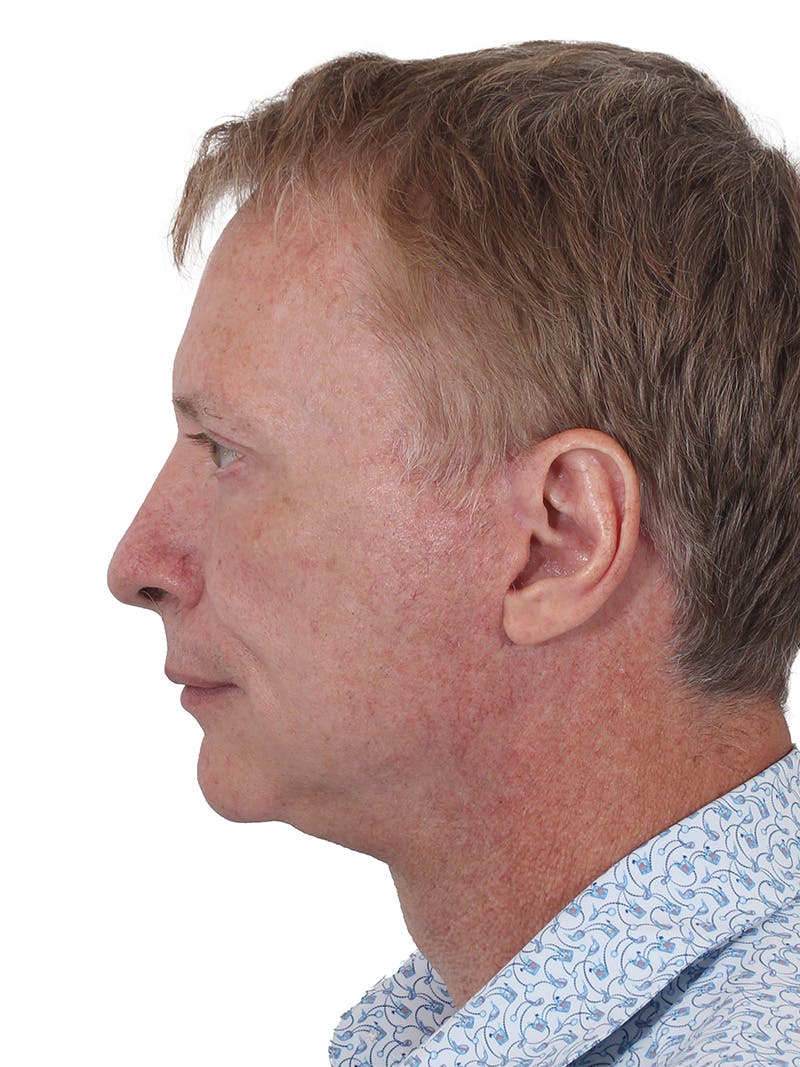 Laser Treatment Before & After Gallery - Patient 223493 - Image 8