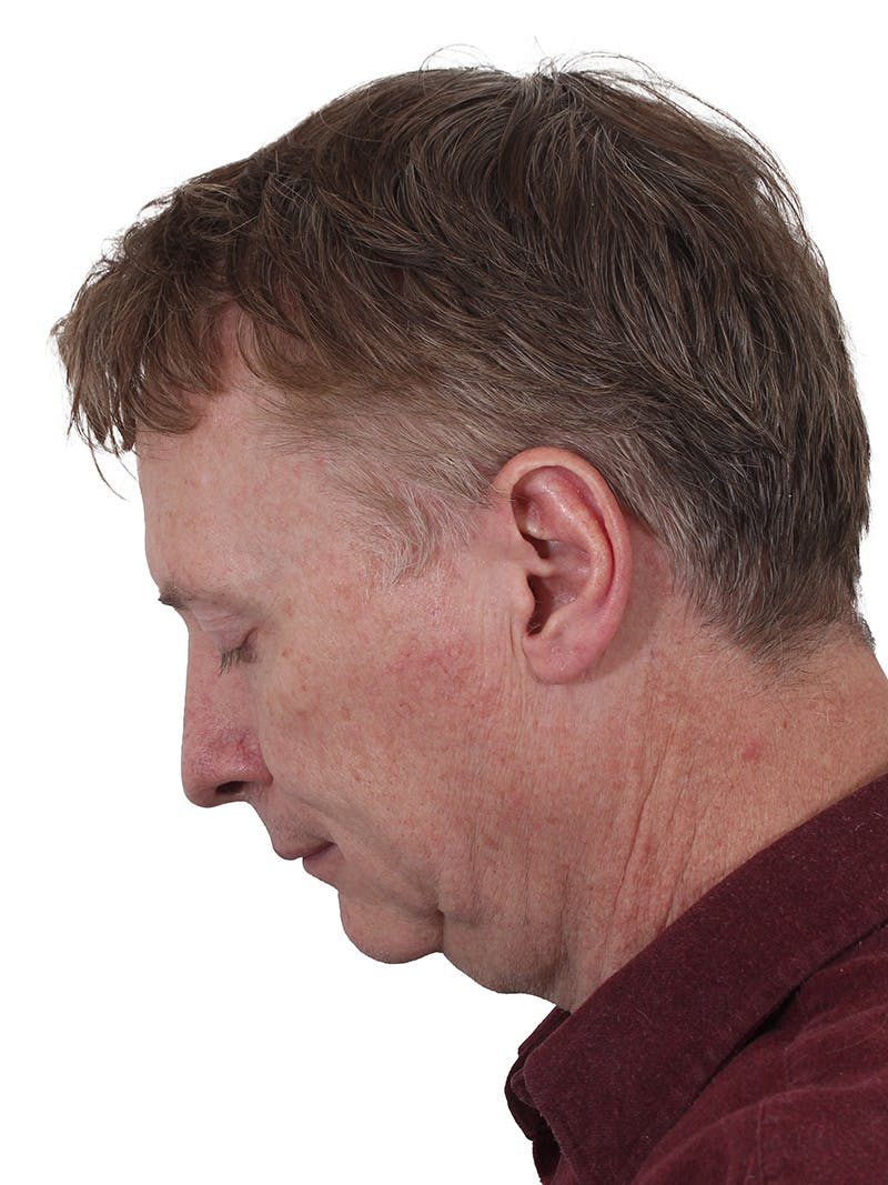 Laser Treatment Before & After Gallery - Patient 223493 - Image 9