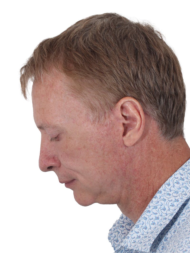 Laser Treatment Before & After Gallery - Patient 223493 - Image 10