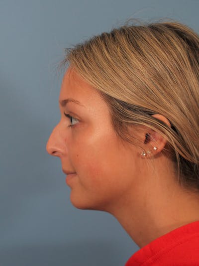 Rhinoplasty Before & After Gallery - Patient 404843 - Image 1