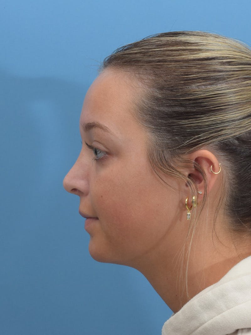Rhinoplasty Before & After Gallery - Patient 404843 - Image 2