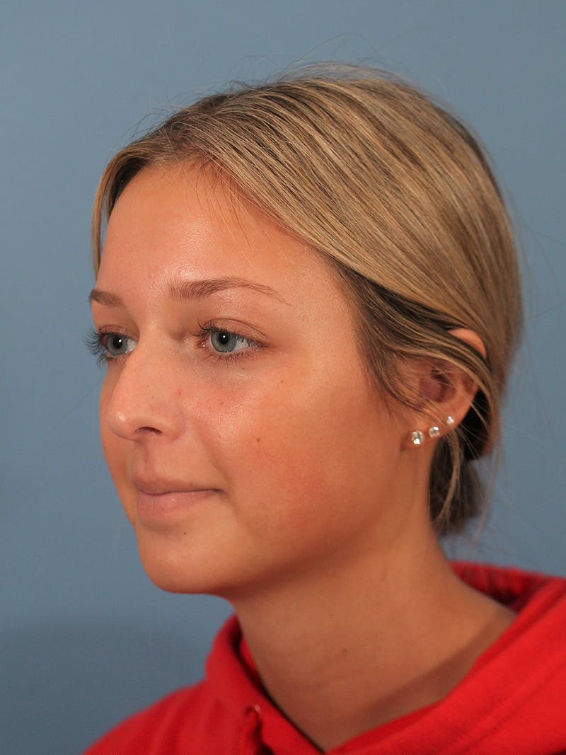 Rhinoplasty Before & After Gallery - Patient 404843 - Image 3