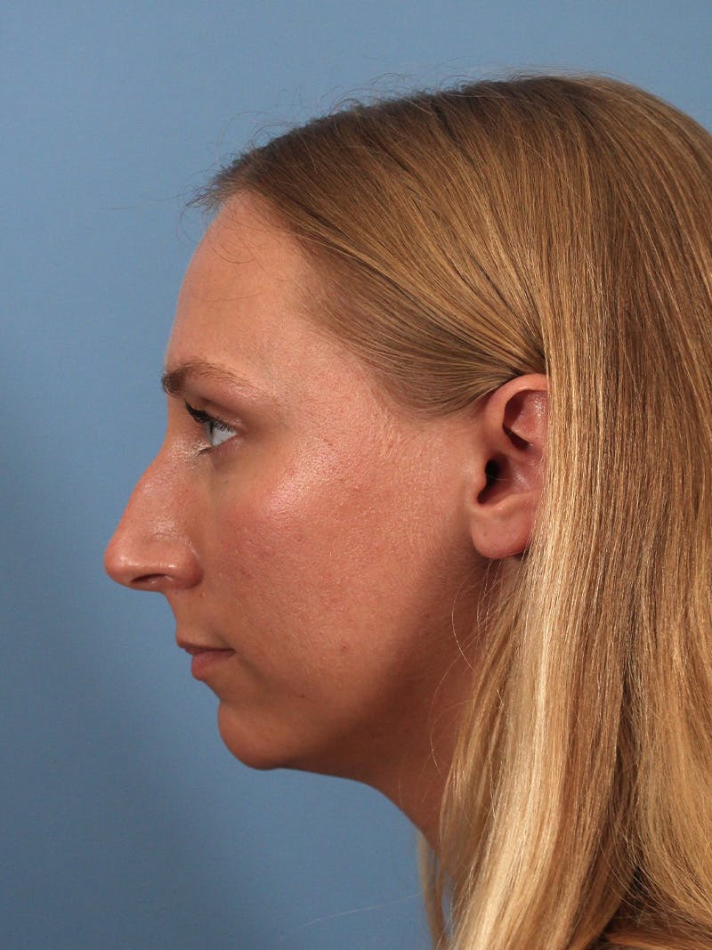 Rhinoplasty Before & After Gallery - Patient 264353 - Image 3