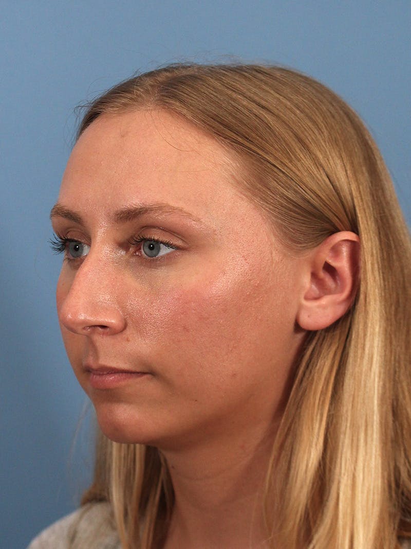 Rhinoplasty Before & After Gallery - Patient 264353 - Image 5