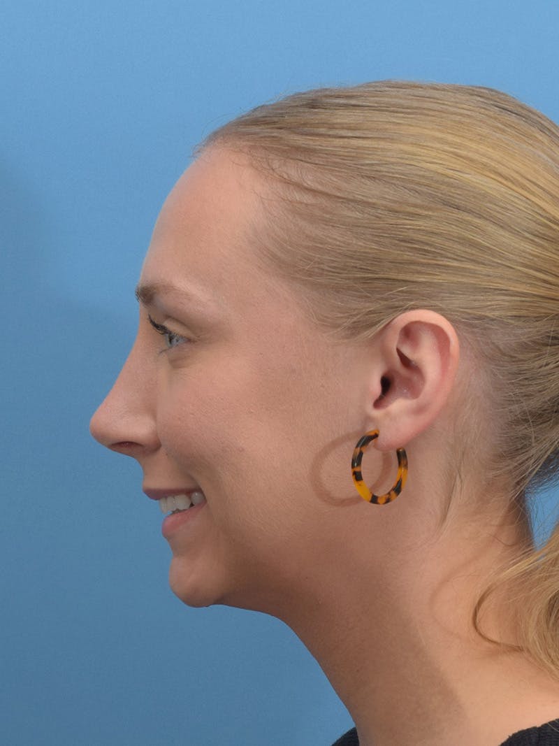 Rhinoplasty Before & After Gallery - Patient 264353 - Image 4