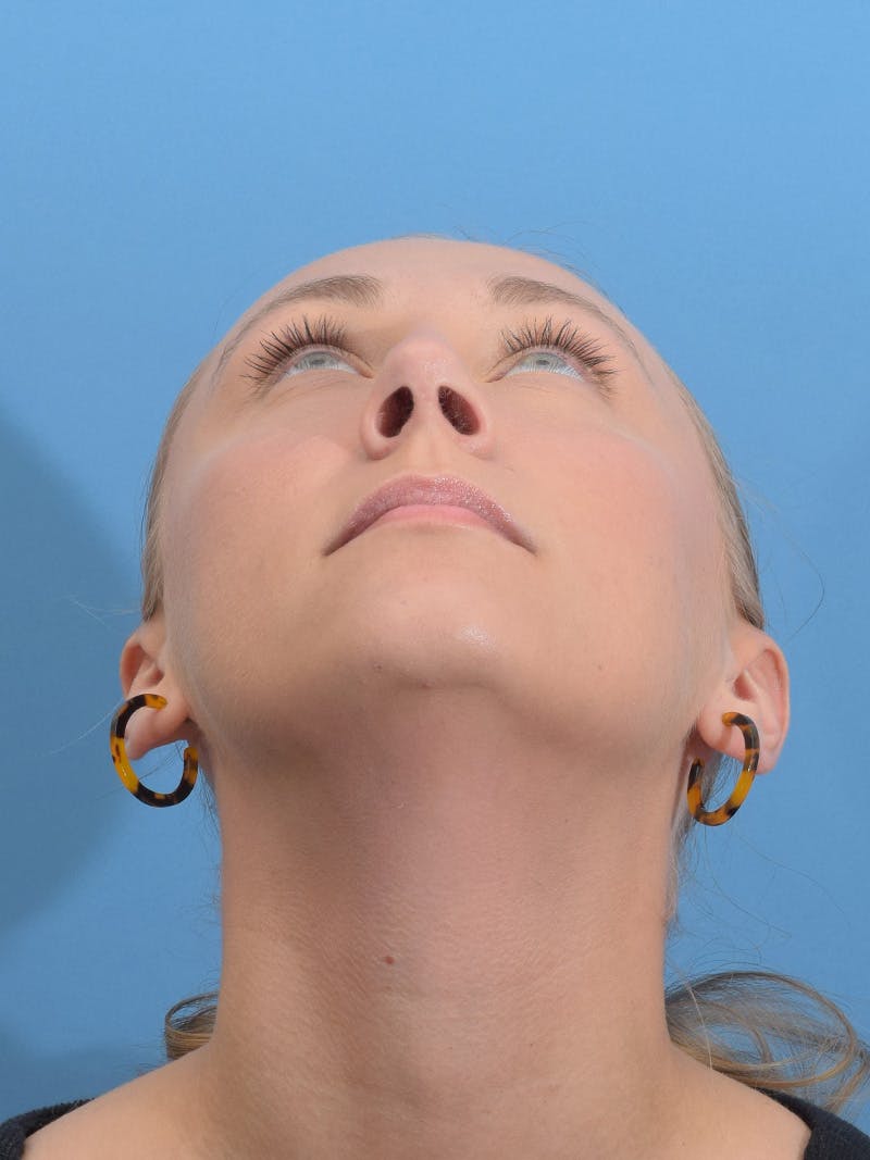 Rhinoplasty Before & After Gallery - Patient 264353 - Image 12