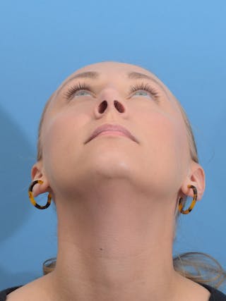 Rhinoplasty Before & After Gallery - Patient 264353 - Image 12