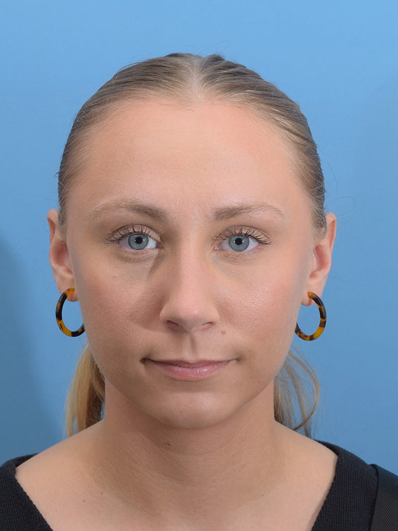 Rhinoplasty Before & After Gallery - Patient 264353 - Image 8