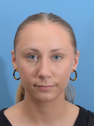 Rhinoplasty Before & After Gallery - Patient 264353 - Image 8