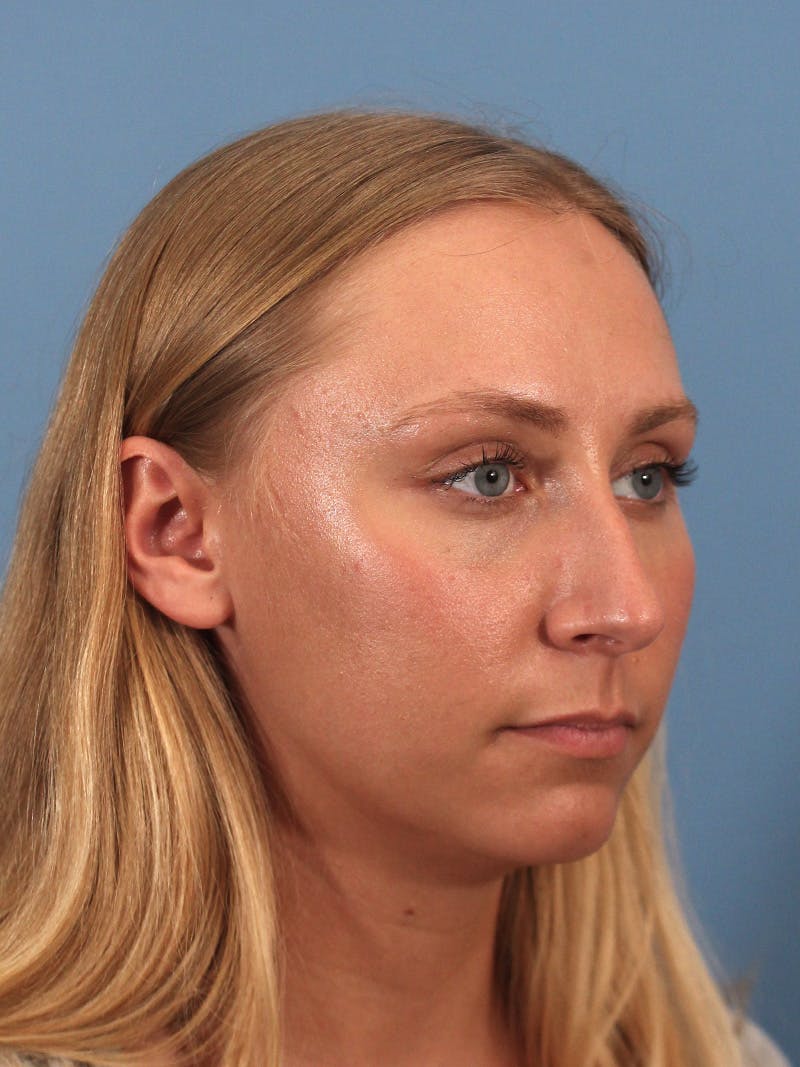 Rhinoplasty Before & After Gallery - Patient 264353 - Image 9