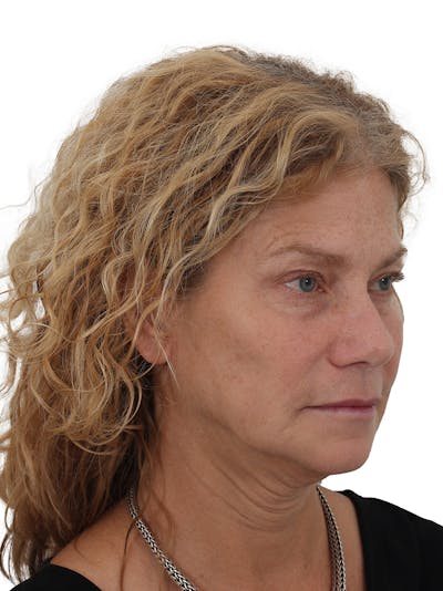 Facelift/Neck Lift Before & After Gallery - Patient 373654 - Image 1