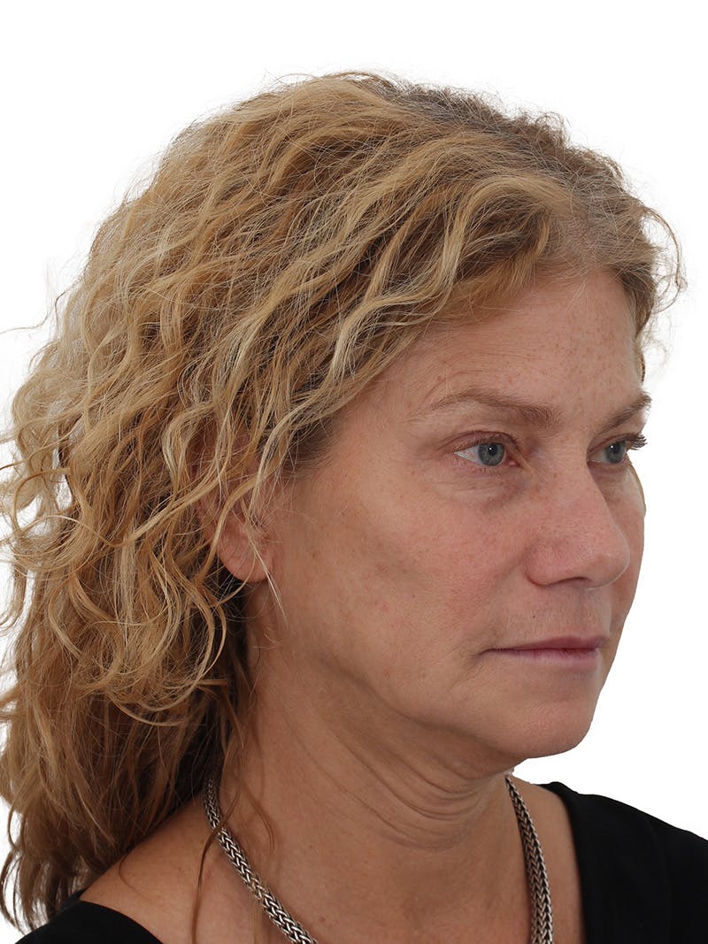 Facelift/Neck Lift Before & After Gallery - Patient 373654 - Image 1