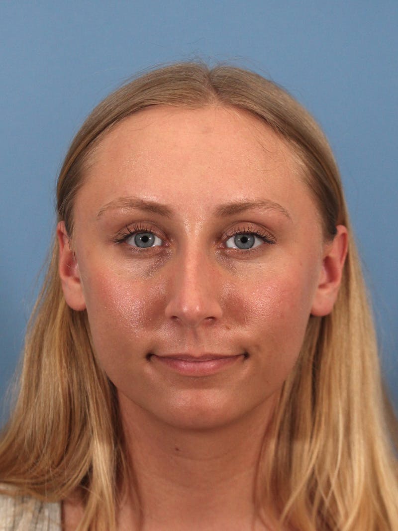 Rhinoplasty Before & After Gallery - Patient 264353 - Image 7