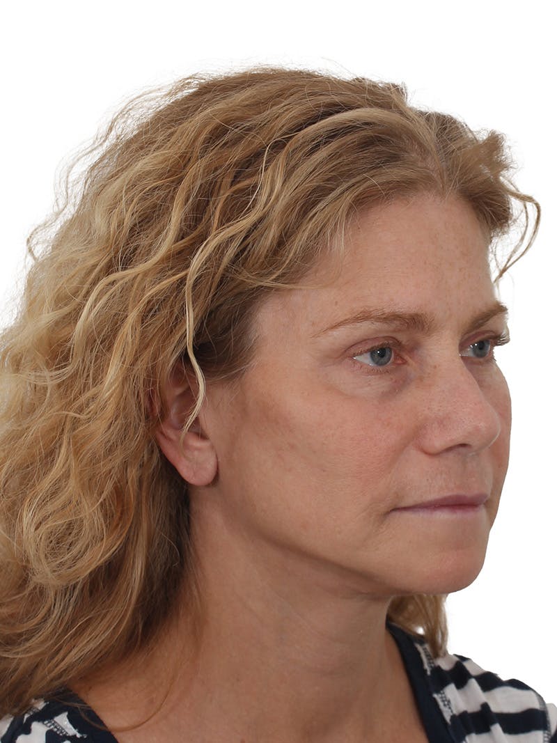 Dr. Frankel’s Facelift in Cleveland Before and After 05