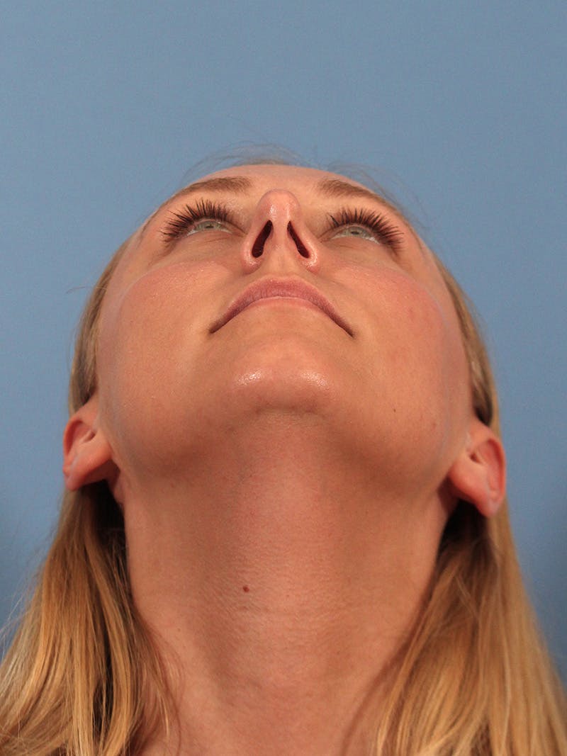 Rhinoplasty Before & After Gallery - Patient 264353 - Image 11