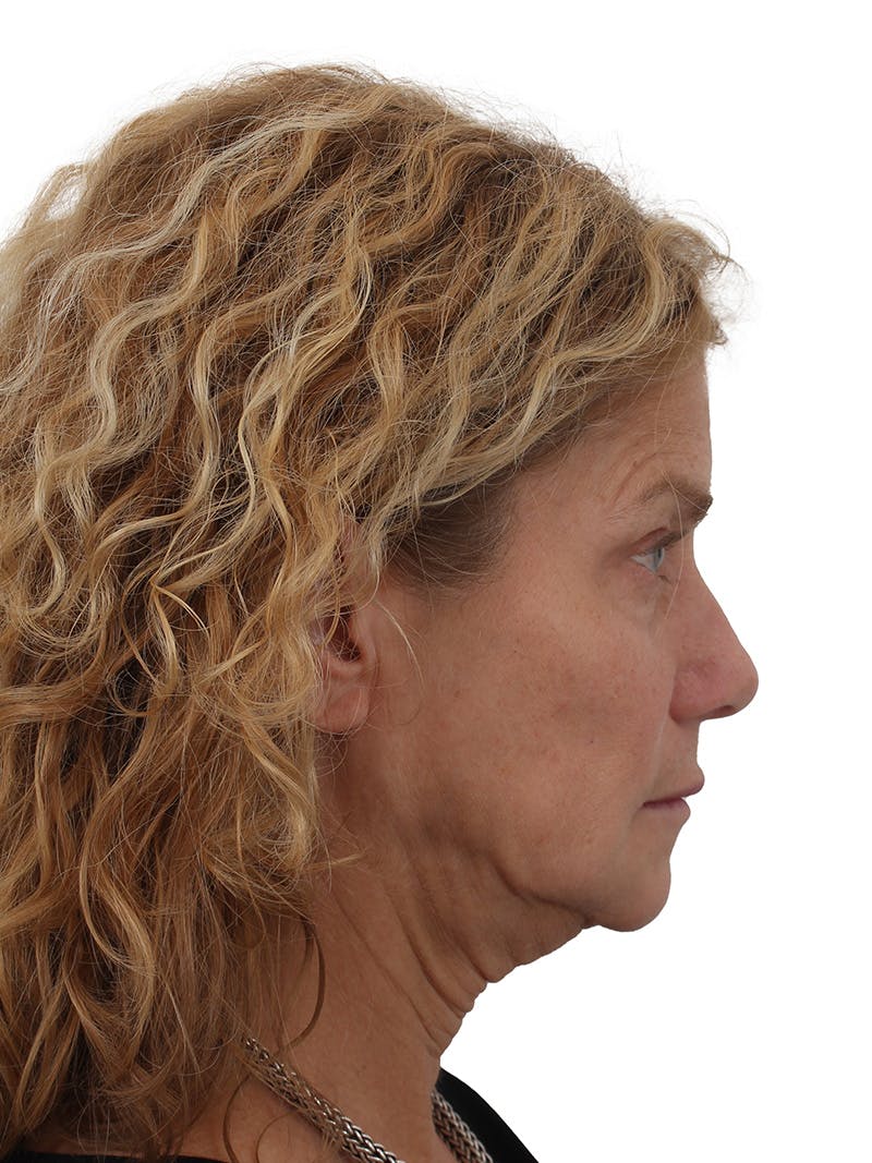 Facelift/Neck Lift Before & After Gallery - Patient 373654 - Image 3