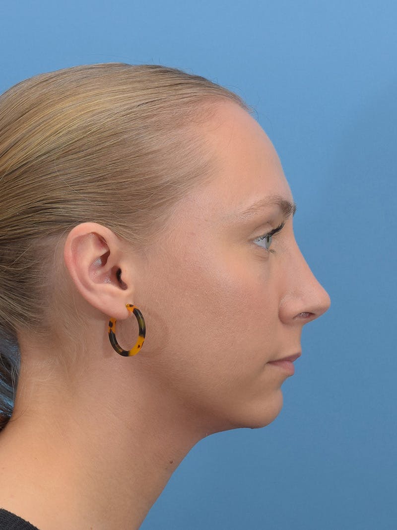 Rhinoplasty Before & After Gallery - Patient 264353 - Image 2