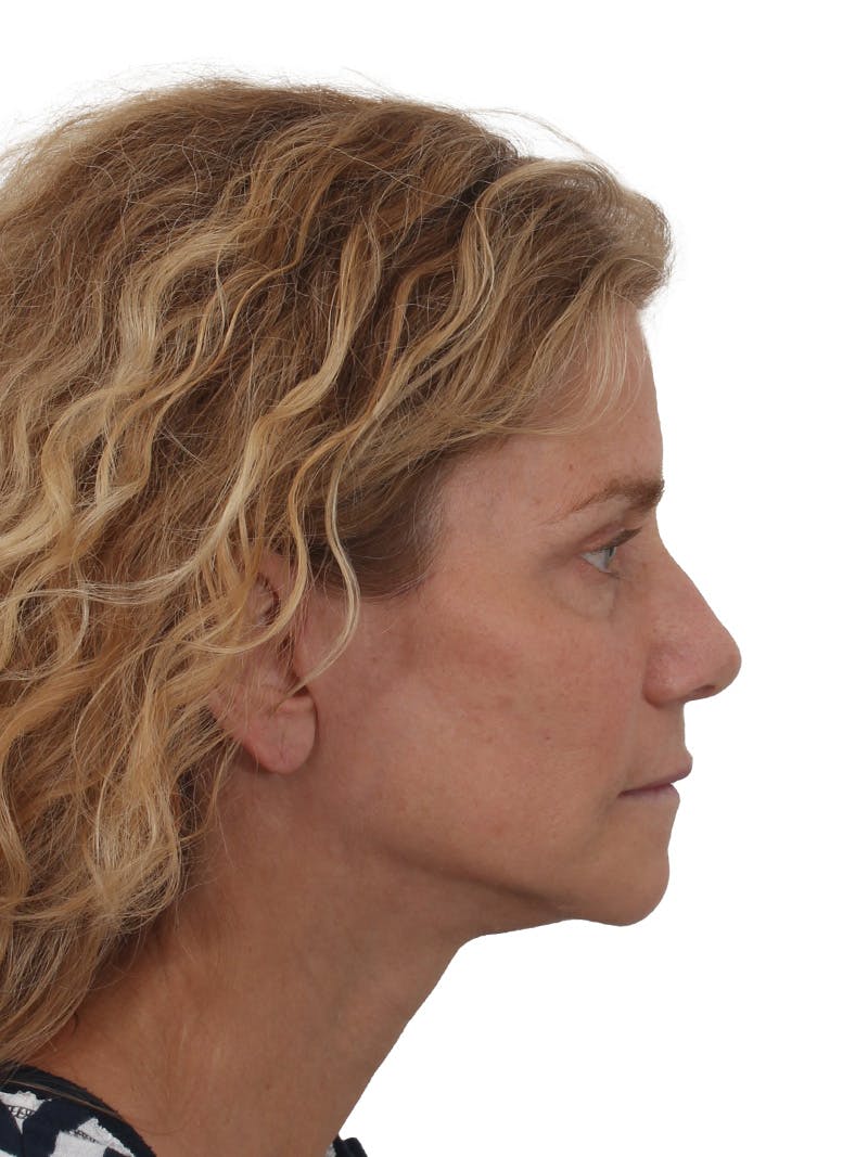 Facelift/Neck Lift Before & After Gallery - Patient 373654 - Image 4