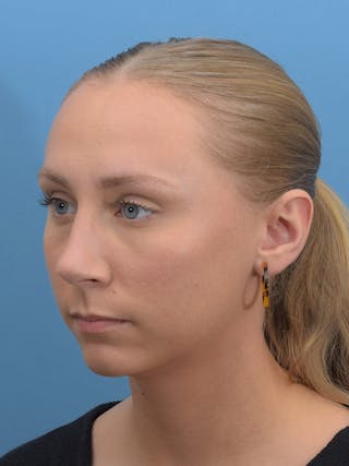 Rhinoplasty Before & After Gallery - Patient 264353 - Image 6