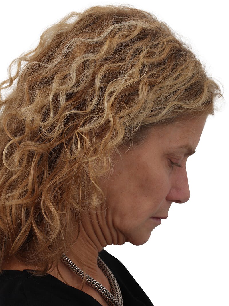 Facelift/Neck Lift Before & After Gallery - Patient 373654 - Image 5