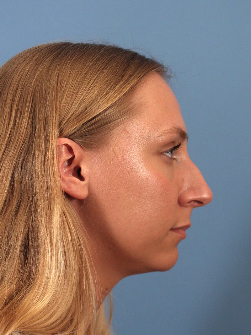Rhinoplasty Before & After Gallery - Patient 264353 - Image 1