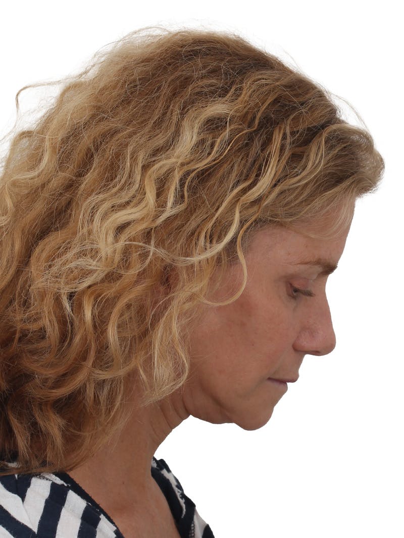 Facelift/Neck Lift Before & After Gallery - Patient 373654 - Image 6