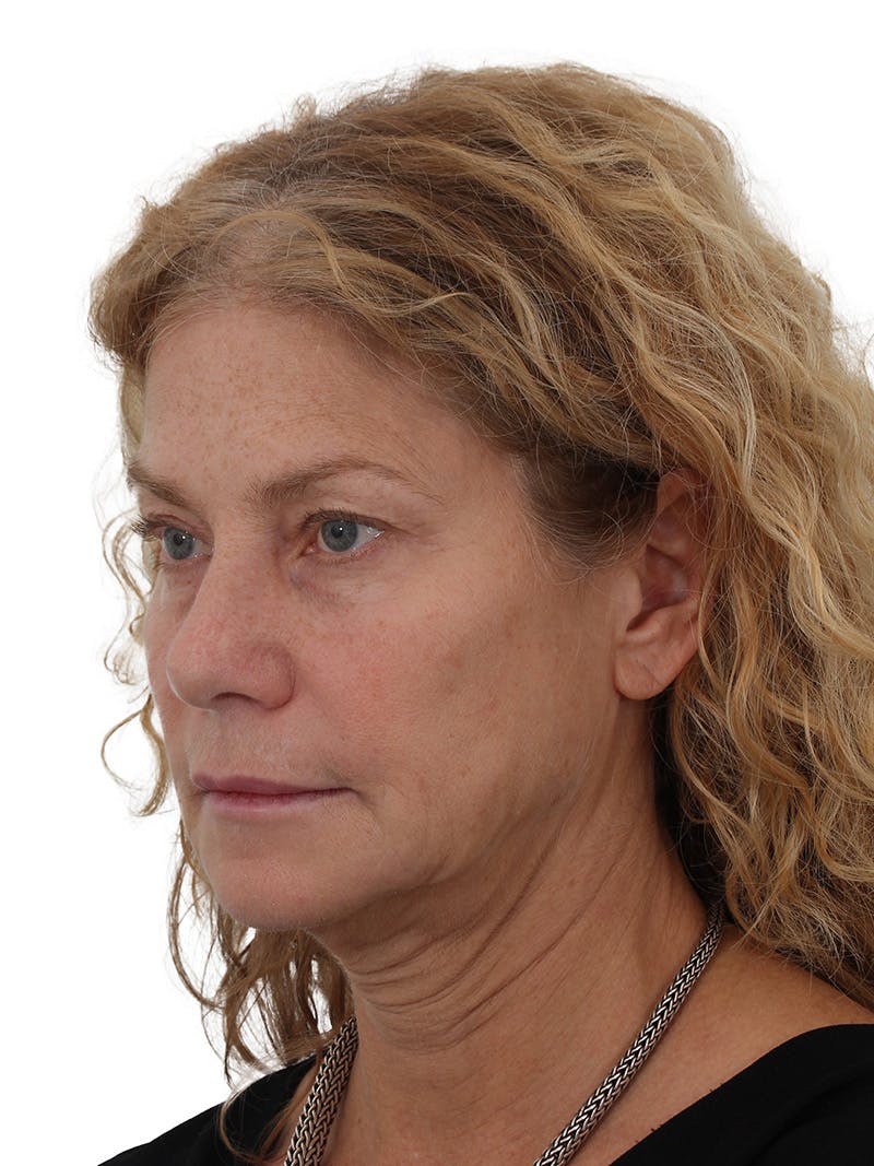 Facelift/Neck Lift Before & After Gallery - Patient 373654 - Image 7