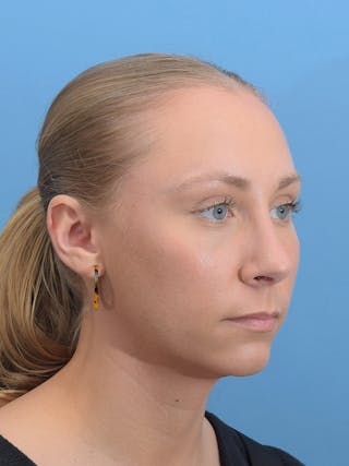 Rhinoplasty Before & After Gallery - Patient 264353 - Image 10