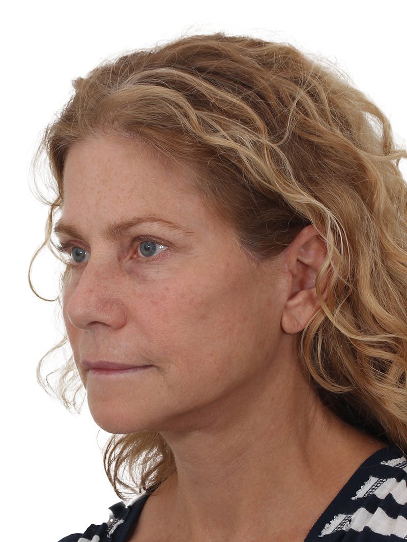 Facelift/Neck Lift Before & After Gallery - Patient 373654 - Image 8