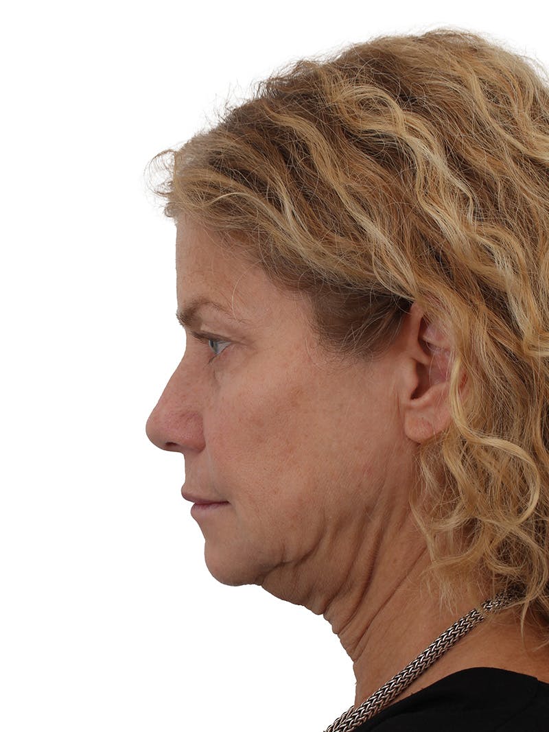 Facelift/Neck Lift Before & After Gallery - Patient 373654 - Image 9