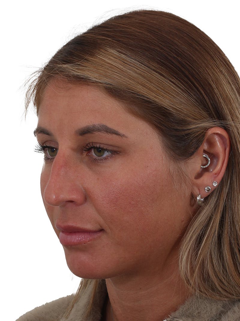 Rhinoplasty Before & After Gallery - Patient 997920 - Image 3