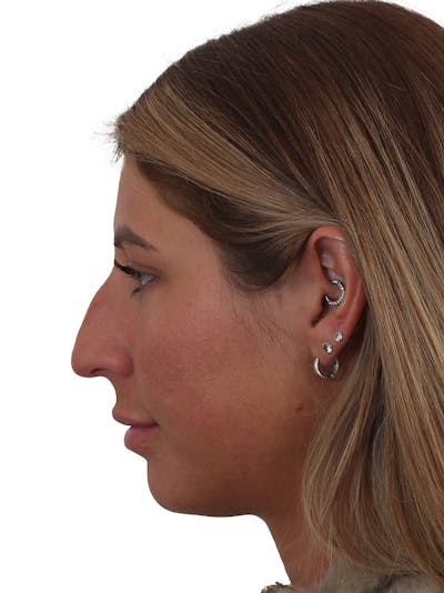 Rhinoplasty Before & After Gallery - Patient 997920 - Image 1