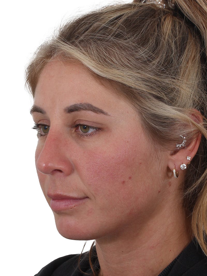 Rhinoplasty Before & After Gallery - Patient 997920 - Image 4