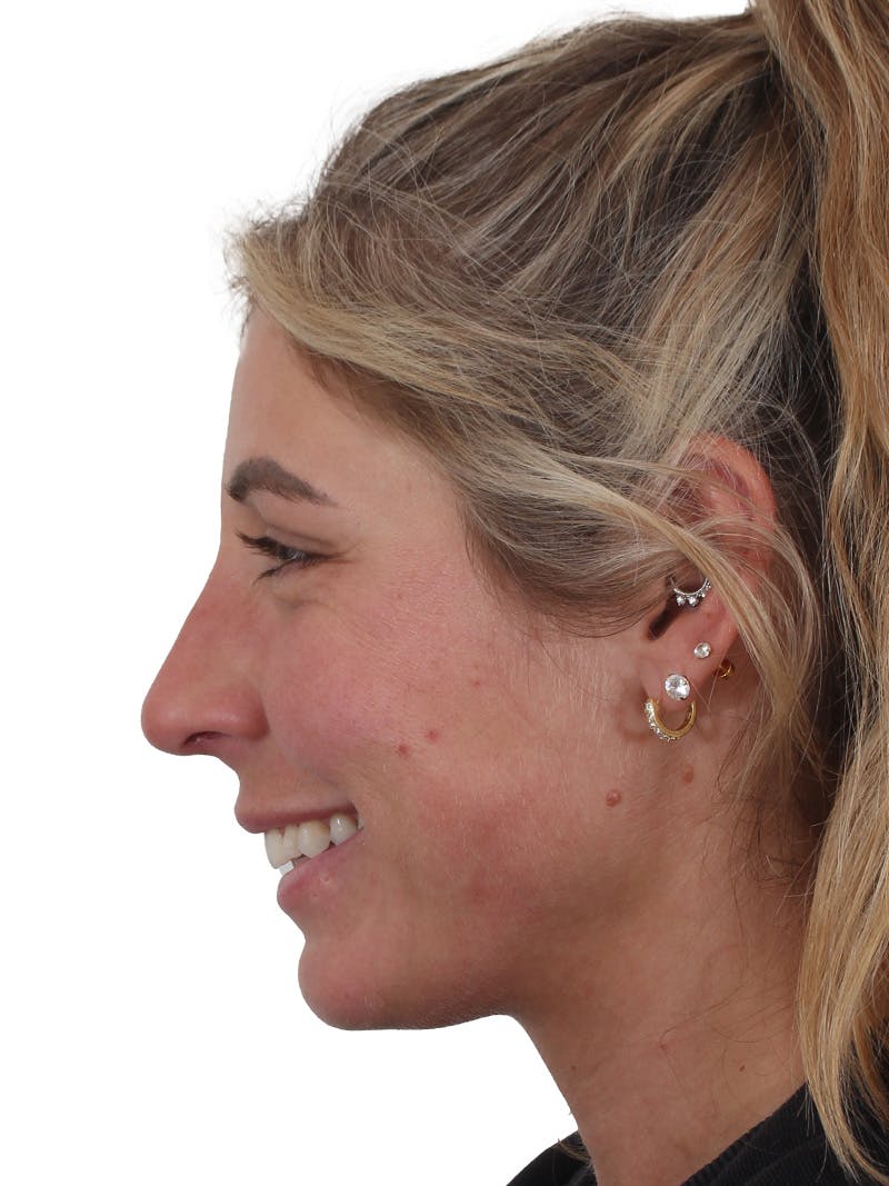 Rhinoplasty Before & After Gallery - Patient 997920 - Image 6