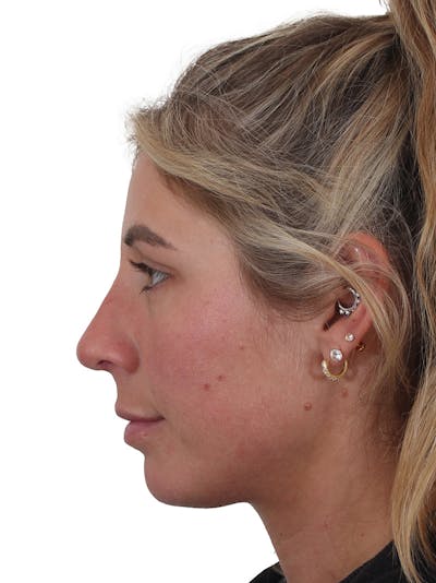 Rhinoplasty Before & After Gallery - Patient 997920 - Image 2