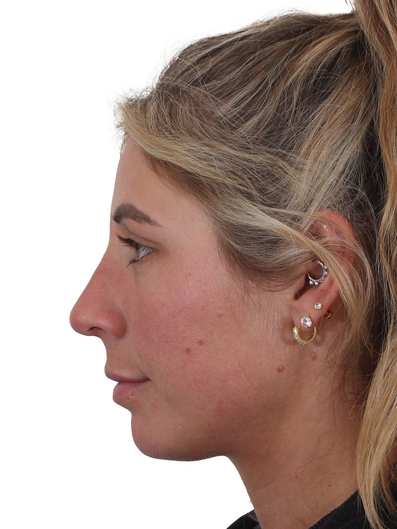 Rhinoplasty Before & After Gallery - Patient 997920 - Image 2