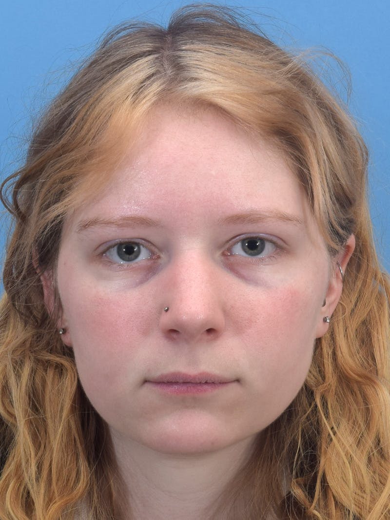 Rhinoplasty Before & After Gallery - Patient 544407 - Image 3