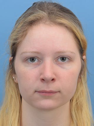 Rhinoplasty Before & After Gallery - Patient 544407 - Image 4