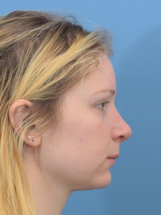Rhinoplasty Before & After Gallery - Patient 544407 - Image 8