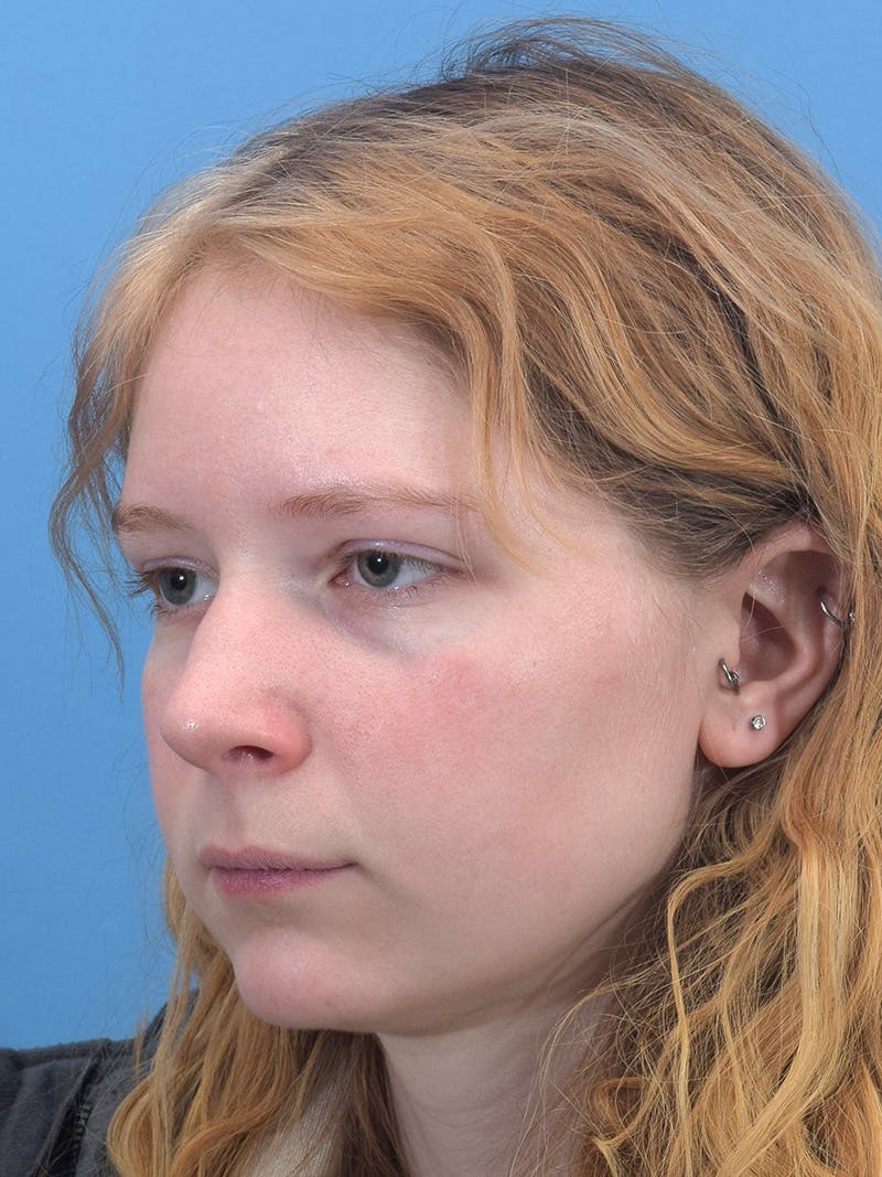 Rhinoplasty Before & After Gallery - Patient 544407 - Image 9