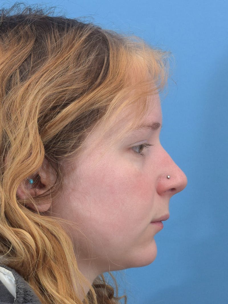 Rhinoplasty Before & After Gallery - Patient 544407 - Image 7