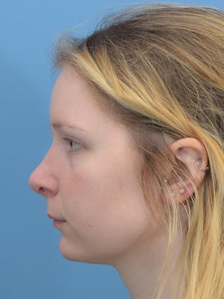 Rhinoplasty Before & After Gallery - Patient 544407 - Image 2